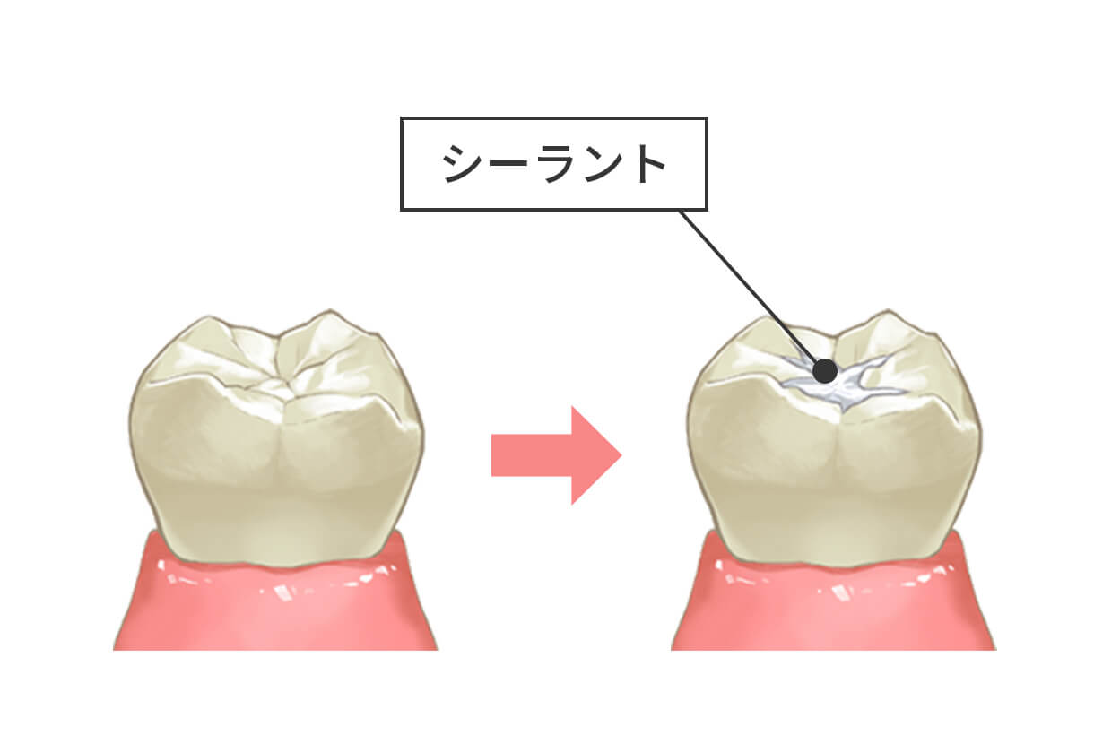 シーラント