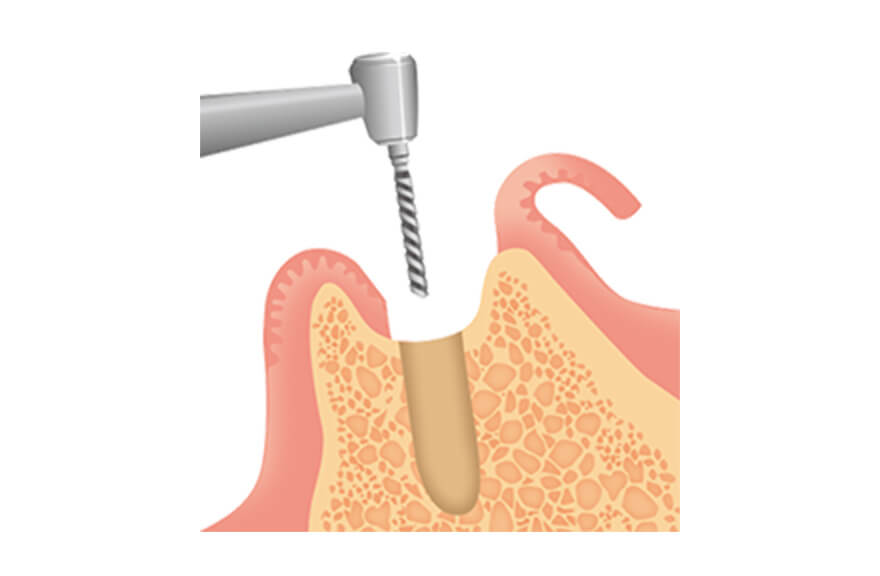 インプラント埋入手術