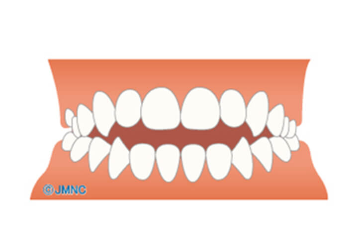 前歯が噛み合わない（開咬）