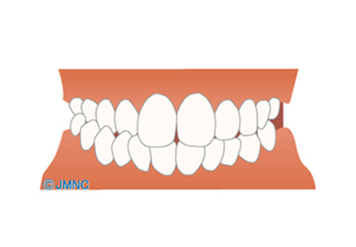噛み合わせが交叉している（交叉咬合）