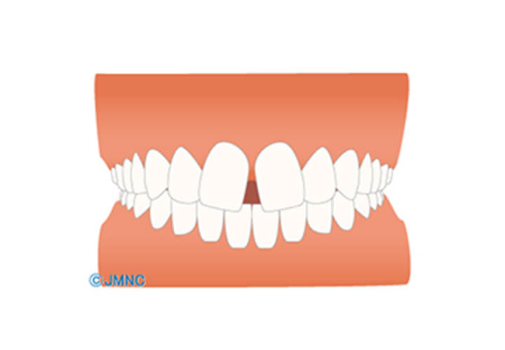 歯の間に隙間がある（正中離開）