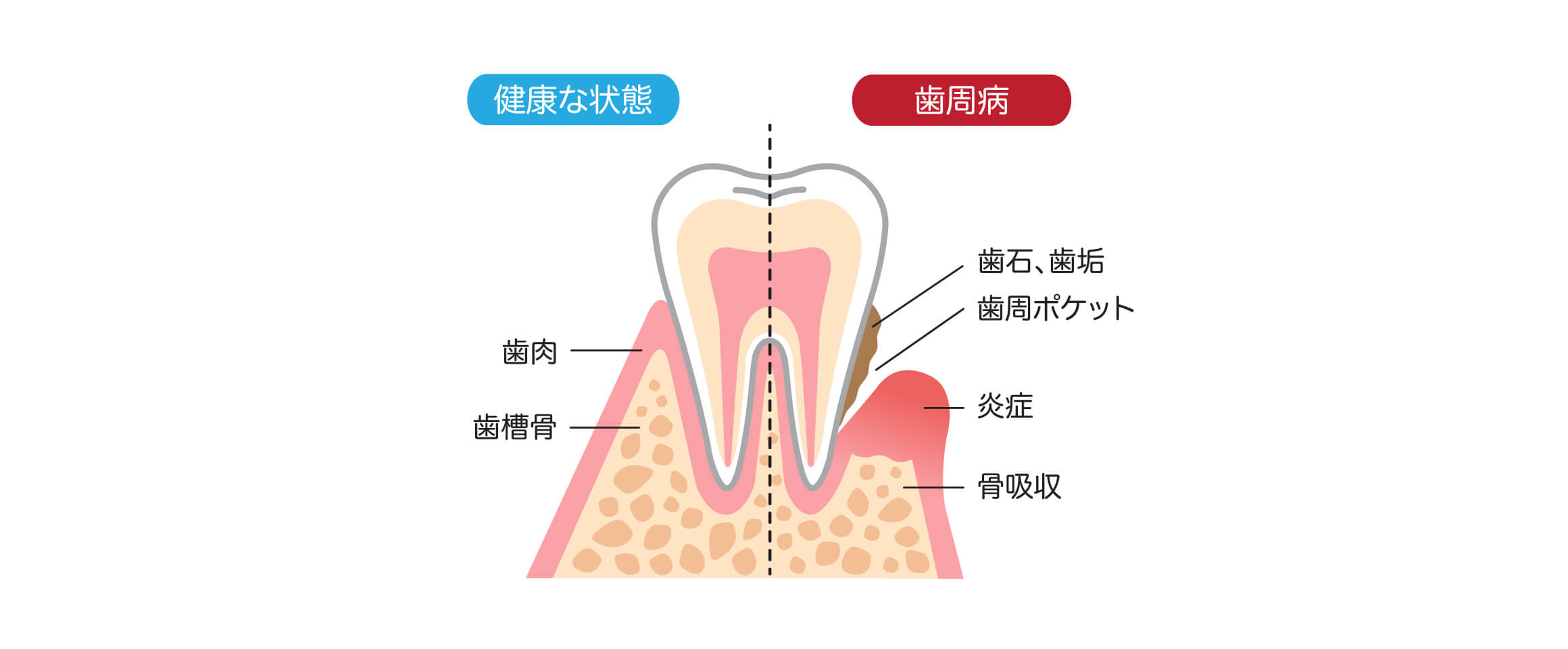 歯周病とは